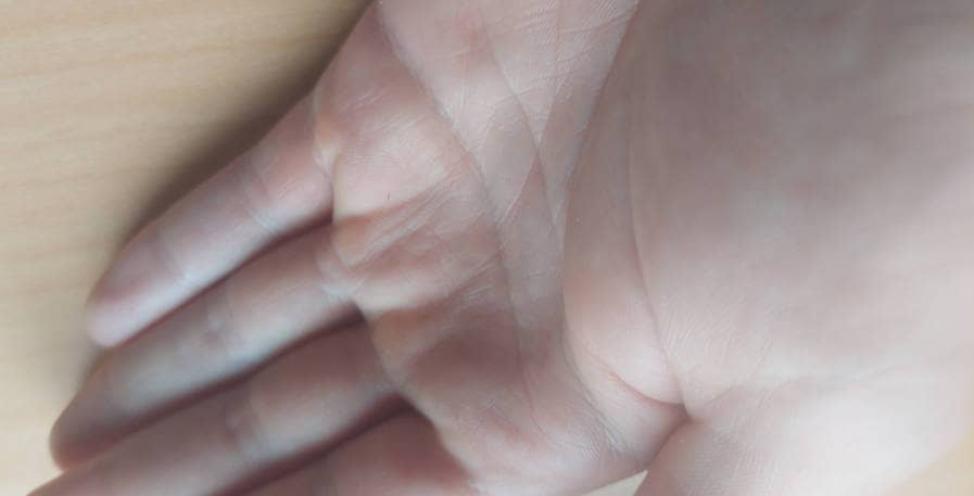 blisters turning into calluses on palm of hand
